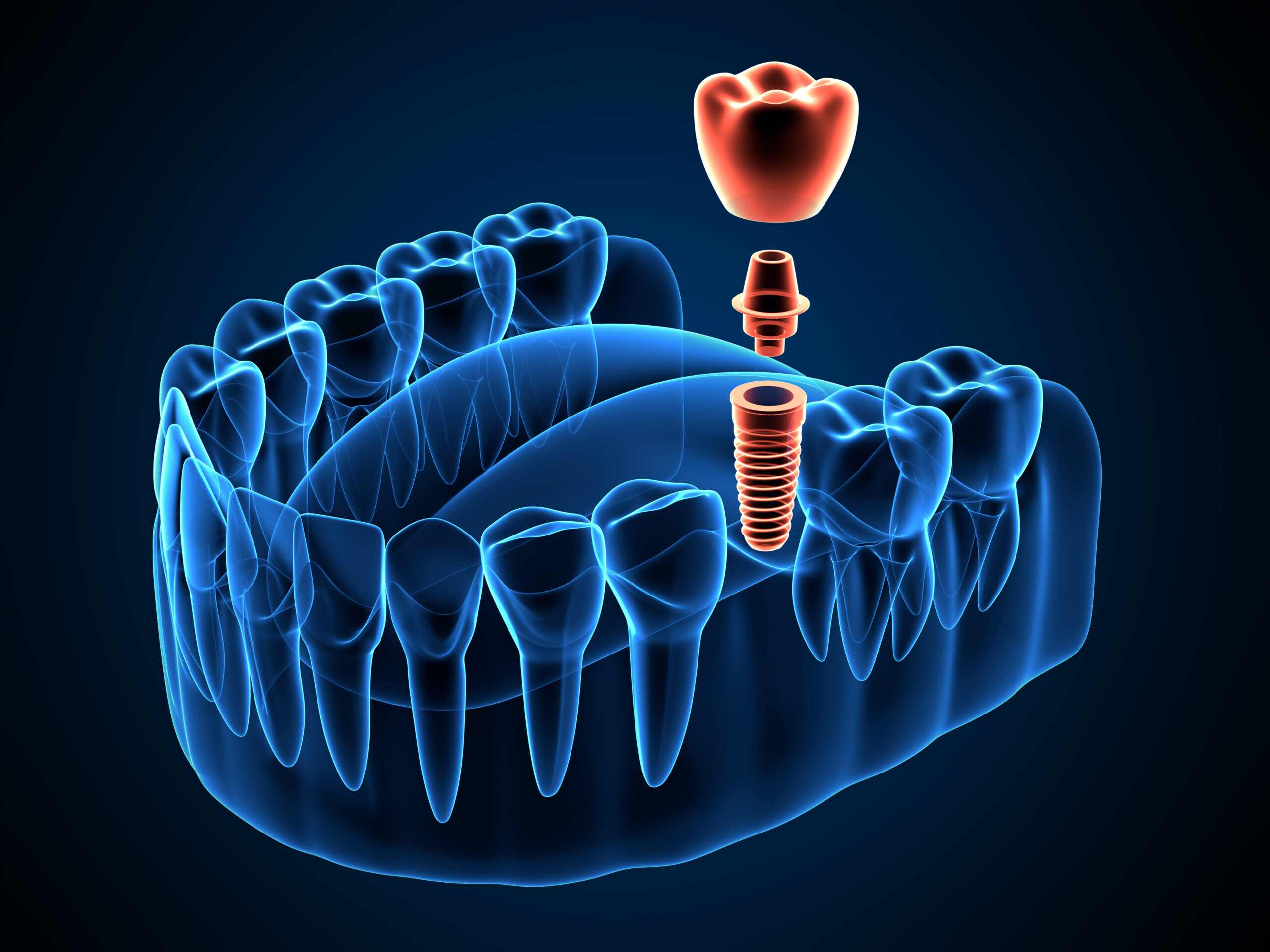 3D illustration of dental implant components, including a crown, abutment, and implant screw, highlighting immediate loading dental implants relevant to dental tourism and patient education.