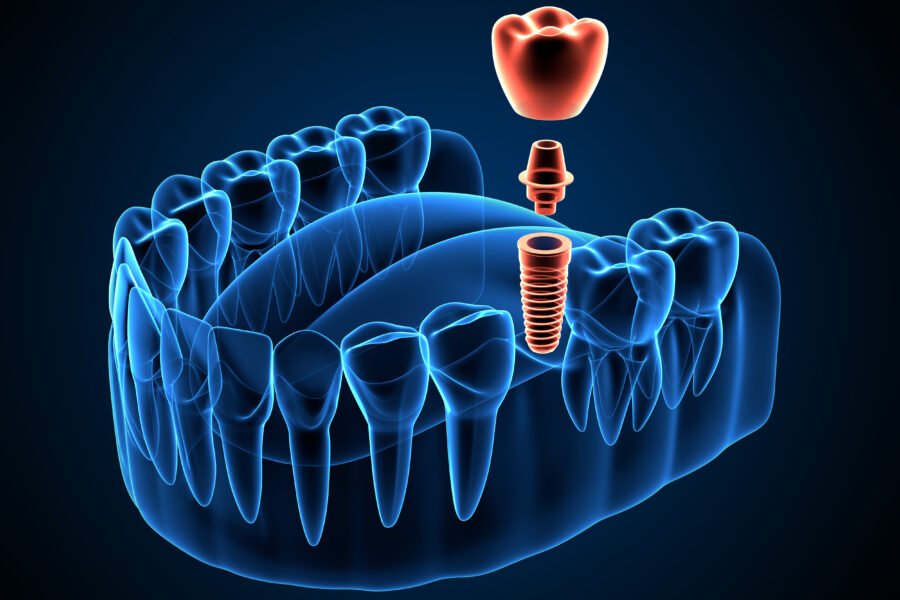 3d render of a jaw x-ray with implant and loading of a prosthetic tooth.