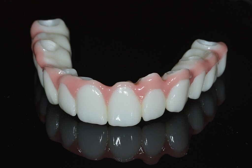 Full zirconia All-on-X prosthesis milled from a single solid zirconia block with lifelike gum and tooth shading.