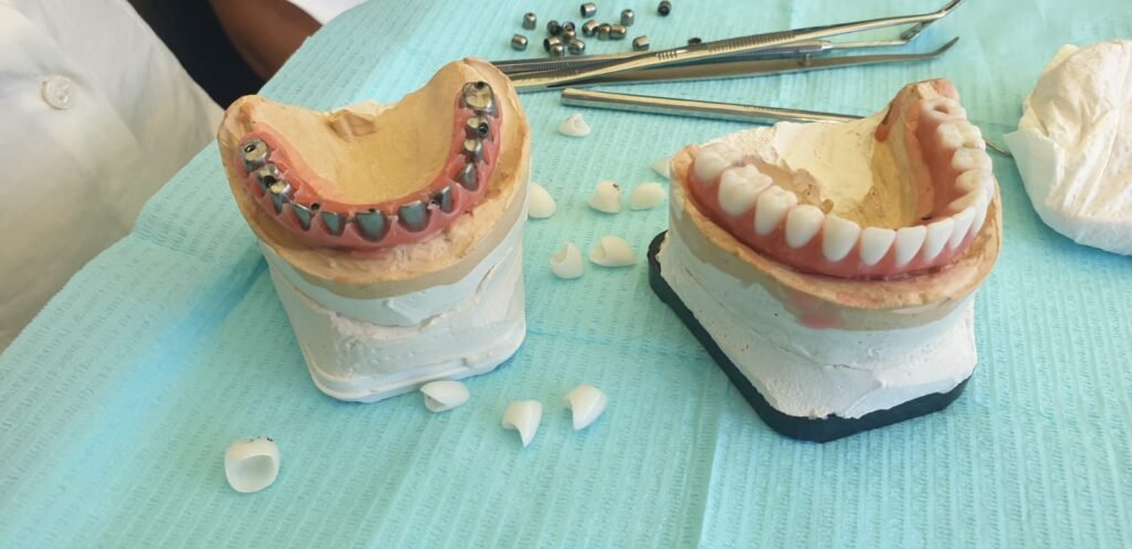 Toronto-style All-on-X prosthesis showing titanium substructure alongside completed version with individual zirconia crowns attached.