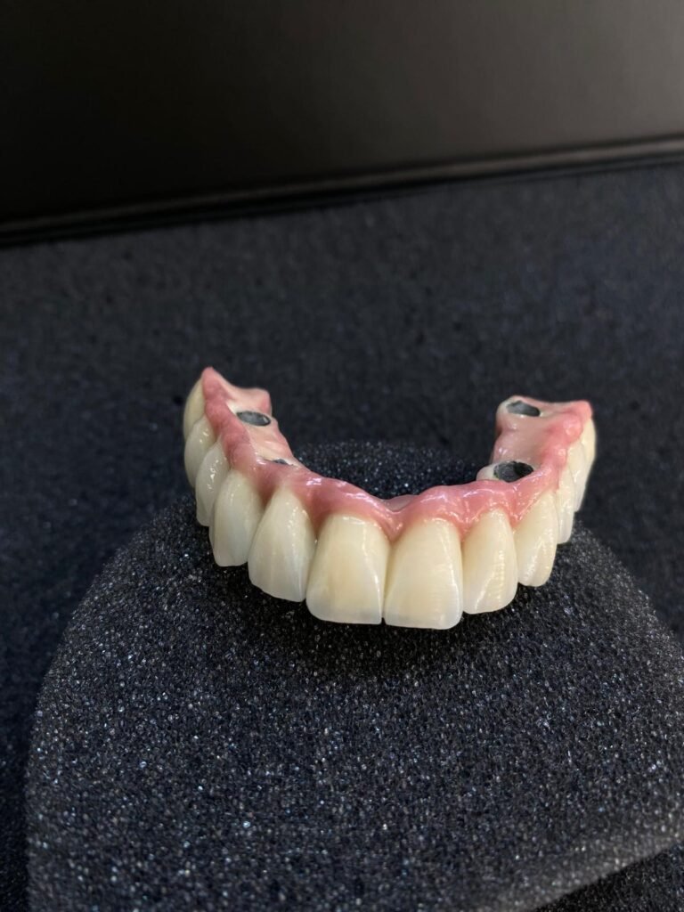 Metal-ceramic All-on-X prosthesis showing porcelain fused to a cobalt-chrome framework, viewed from the front.