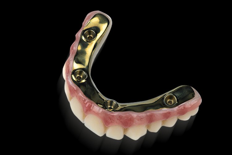 Hybrid zirconia All-on-X prosthesis supported by a titanium bar, showing precision fit between zirconia and metal framework.