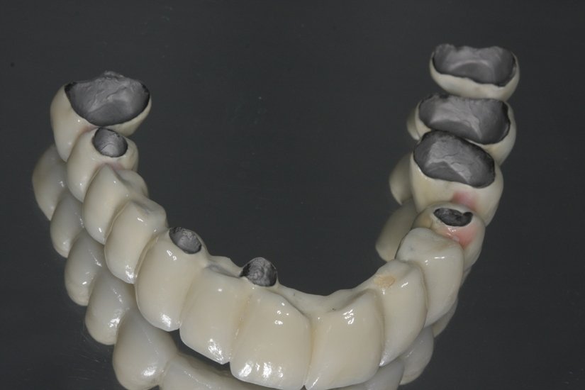A metal-ceramic prosthesis highlighting the thin metal substructure beneath the porcelain layer.