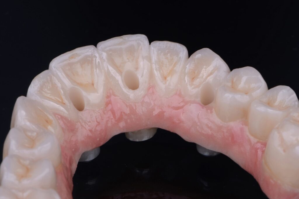 Monolithic zirconia dental prosthesis showcasing natural gum contour and tooth coloration, highlighting durability and design for All-on-X dental implants.