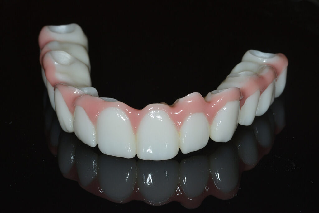 Monolithic zirconia dental prosthesis with natural gum contour, showcasing durability and esthetics, reflecting advanced digital design for All-on-X implants.