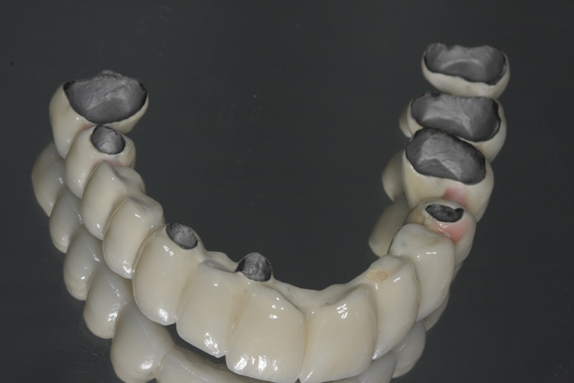 Metal-ceramic dental prosthesis showcasing a metal framework with porcelain layers, illustrating strength and traditional design for All-on-X dental implants.