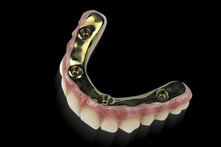 Hybrid zirconia prosthesis supported by a titanium bar, showcasing structural design and aesthetic features, relevant to All-on-X dental implant options.