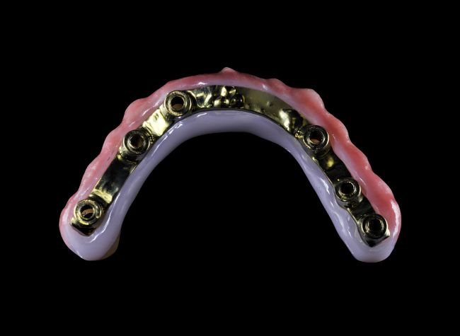 Hybrid zirconia prosthesis supported by titanium bar, showcasing structural components and aesthetic design for dental implants.