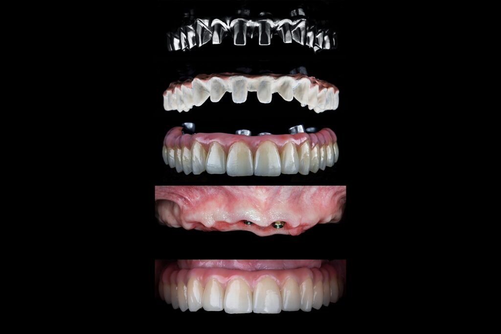 Toronto-style hybrid prosthesis layers showcasing custom titanium framework, zirconia crowns, and gum tissue simulation for dental implants.