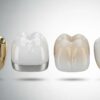 Dental crown materials comparison: gold, porcelain fused to metal (PFM), zirconia, and all-ceramic crowns, showcasing variations in color and structure.