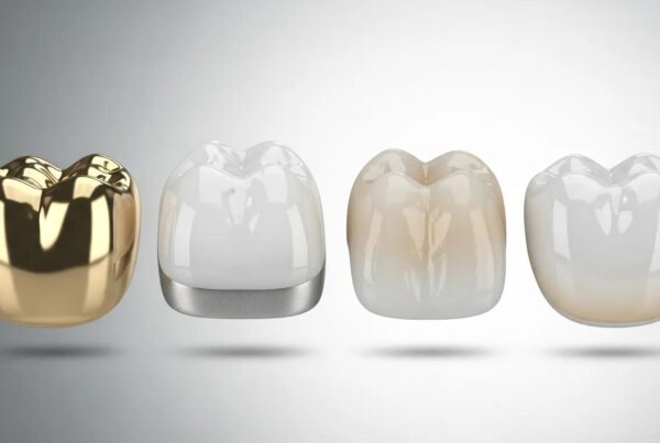 Dental crown materials comparison: gold, porcelain fused to metal (PFM), zirconia, and all-ceramic crowns, showcasing variations in color and structure.