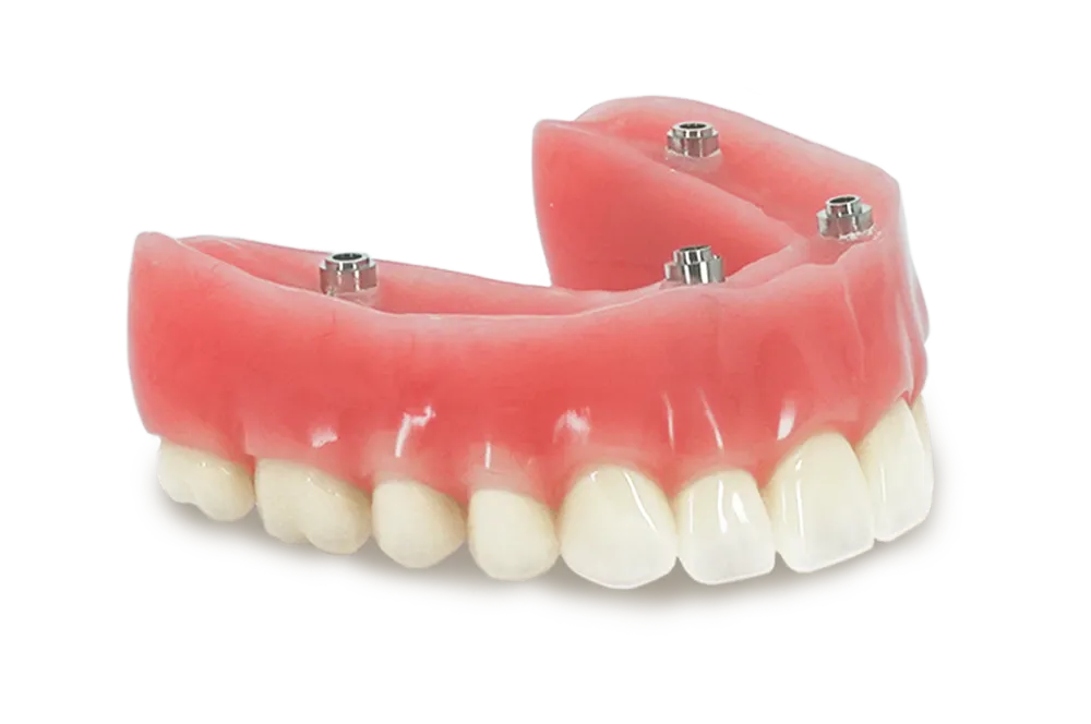 Upper acrylic hybrid denture for All-on-4, with four screw-access cylinders for fixing to the implants.
