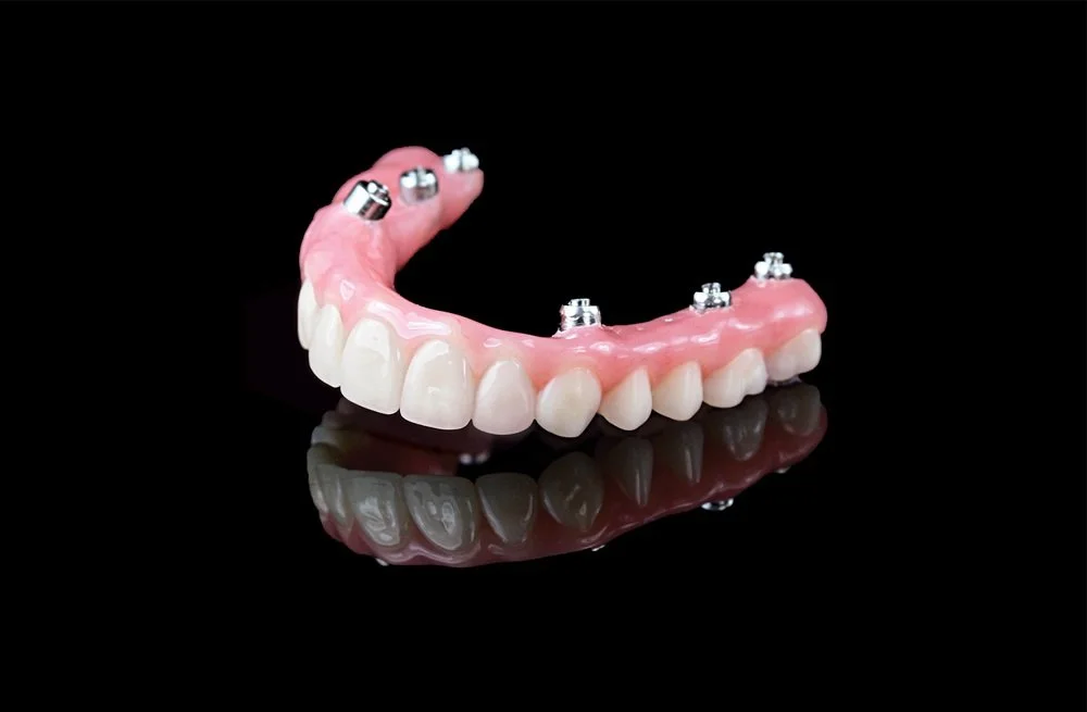 Upper acrylic hybrid prosthesis for All-on-6, with acrylic teeth and pink gums and six screw-access cylinders for the implants.